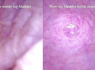 POV Endoscope Catheter Bladder Inflation - Preview